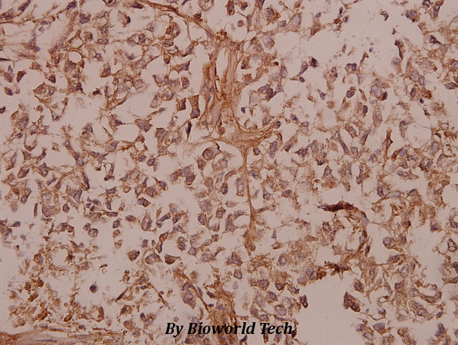 Immunohistochemistry (IHC) analyzes of COL5A1 (E325) pAb in paraffin-embedded human colorectal carcinoma tissue at 1:50.