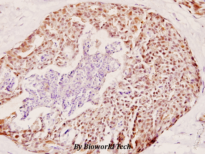 Immunohistochemistry (IHC) analyzes of COX6c (R40) pAb in paraffin-embedded human breast carcinoma tissue at 1:100.