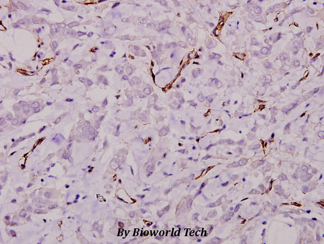 Immunohistochemistry (IHC) analyzes of Laminin γ-1 (E1472) pAb in paraffin-embedded human breast carcinoma tissue at 1:50.