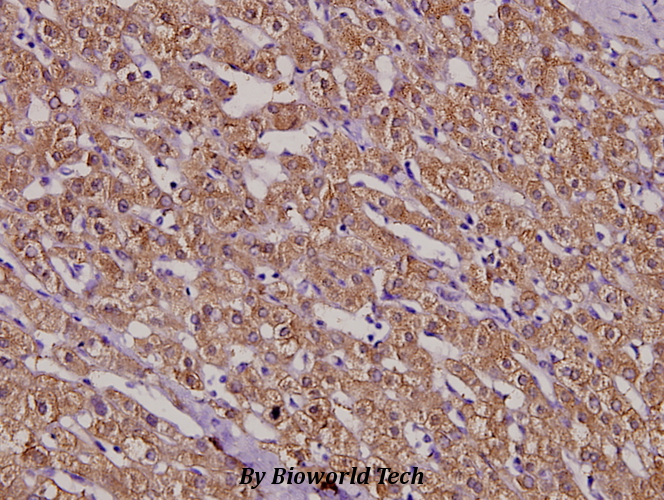 Immunohistochemistry (IHC) analyzes of MSH3 (A80) pAb in paraffin-embedded liver cancer tissue at 1:100.