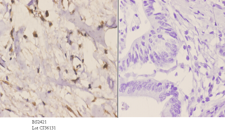 Immunohistochemistry (IHC) analyzes of Rad51C (E185) pAb in paraffin-embedded human colon carcinoma tissue at 1:50.showing cytoplasmic and nucleus staining. Negative control (the right)Using PBS instead of primary antibody, secondary antibody is Goat Anti-Rabbit IgG-biotin followed by avidin-peroxidase.