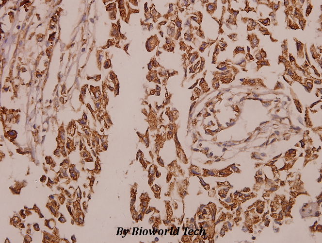 Immunohistochemistry (IHC) analyzes of Rad23B (K27) pAb in paraffin-embedded human colorectal carcinoma tissue at 1:50.
