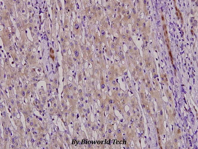 Immunohistochemistry (IHC) analyzes of NF-YC (W85) pAb in paraffin-embedded liver cancer tissue at 1:100.