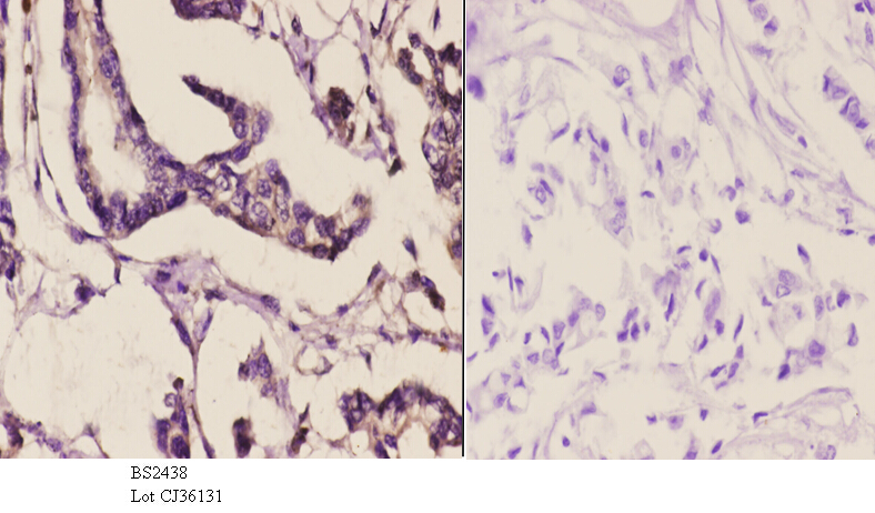 Immunohistochemistry (IHC) analyzes of ERK8 (D171) pAb in paraffin-embedded human breast carcinoma tissue at 1:50.showing cell membrane staining. Negative control (the right)Using PBS instead of primary antibody, secondary antibody is Goat Anti-Rabbit IgG-biotin followed by avidin-peroxidase.