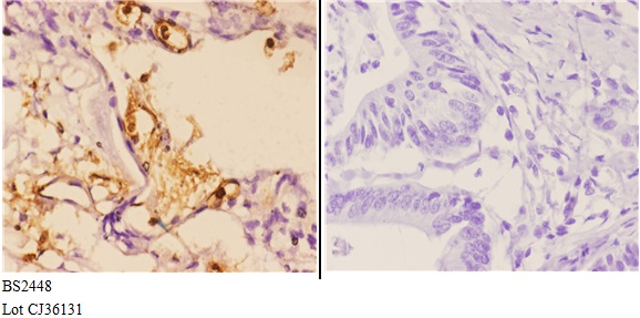 Immunohistochemistry (IHC) analyzes of Hrs (R481) pAb in paraffin-embedded human colon carcinoma tissue at 1:50.showing Cytoplasm and Nucleus staining. Negative control (the right)Using PBS instead of primary antibody, secondary antibody is Goat Anti-Rabbit IgG-biotin followed by avidin-peroxidase.
