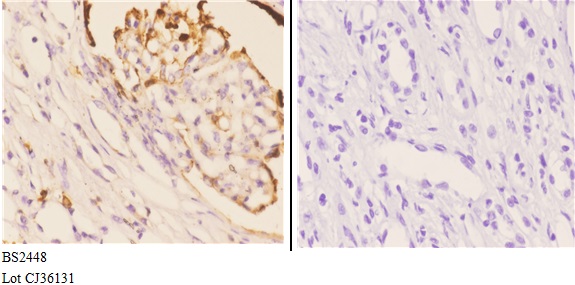 Immunohistochemistry (IHC) analyzes of Hrs (R481) pAb in paraffin-embedded human kidney carcinoma tissue at 1:50.showing Cytoplasm and Nucleus staining. Negative control (the right)Using PBS instead of primary antibody, secondary antibody is Goat Anti-Rab
