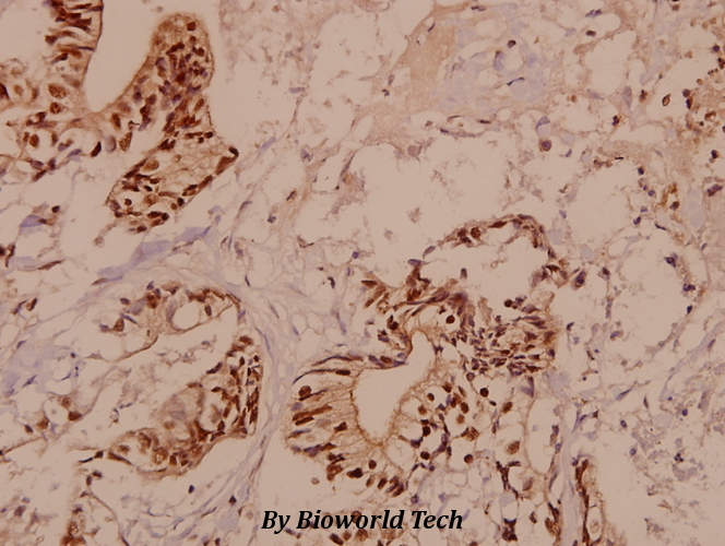 Immunohistochemistry (IHC) analyzes of LUCA15 (N261) pAb in paraffin-embedded human colorectal carcinoma tissue at 1:50.