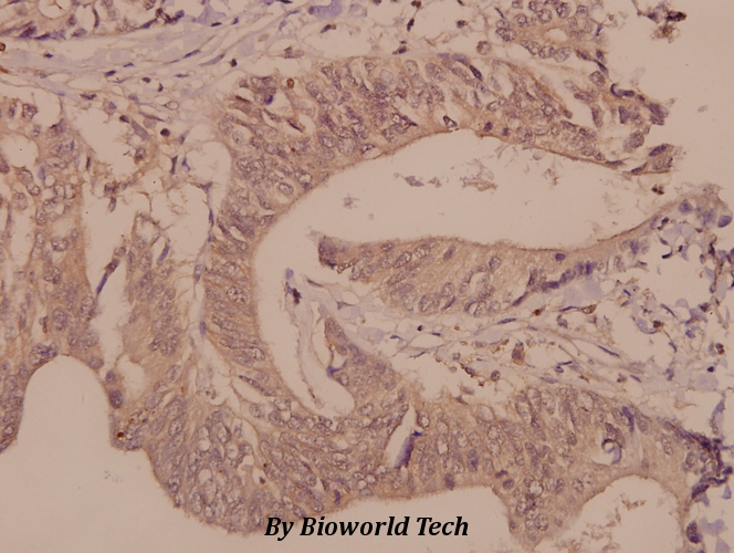 Immunohistochemistry (IHC) analyzes of DGK-θ (S725) pAb in paraffin-embedded human colorectal carcinoma tissue at 1:50.