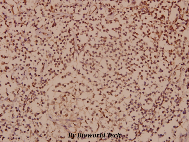 Immunohistochemistry (IHC) analyzes of Sox8/9/17/18 (K148) pAb in paraffin-embedded human colorectal carcinoma tissue at 1:50.