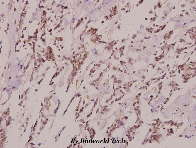 Immunohistochemistry (IHC) analyzes of Pitx1 (E130) pAb in paraffin-embedded human breast carcinoma tissue at 1:100.