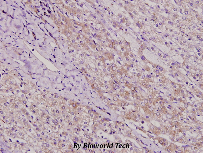 Immunohistochemistry (IHC) analyzes of TAF II p100 (G411) pAb in paraffin-embedded liver cancer tissue at 1:100.