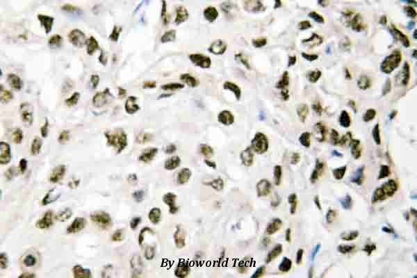 Immunohistochemistry (IHC) analyzes of VPS72 (Q149) pAb in paraffin-embedded human breast cancer tissue.