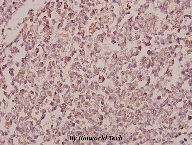 Immunohistochemistry (IHC) analyzes of RhoBTB1/2 (T85) pAb in paraffin-embedded human tonsil carcinoma tissue at 1:50.
