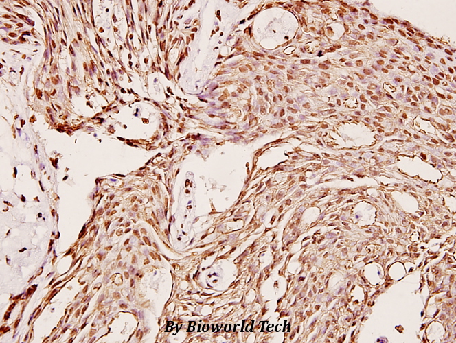 Immunohistochemistry (IHC) analyzes of CYP2C19 (K270) pAb in paraffin-embedded human breast carcinoma tissue at 1:100.