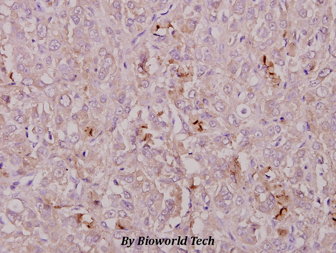 Immunohistochemistry (IHC) analyzes of COL1A2 (T501) pAb in paraffin-embedded human breast carcinoma tissue at 1:50.
