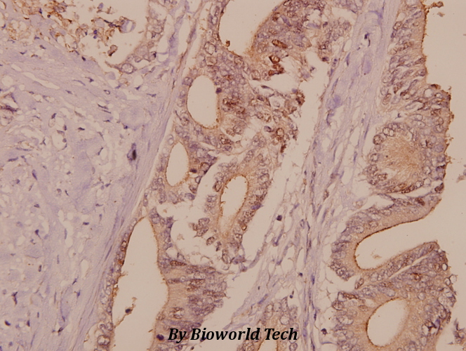 Immunohistochemistry (IHC) analyzes of DNA Ligase I (E139) pAb in paraffin-embedded human colorectal carcinoma tissue at 1:50.