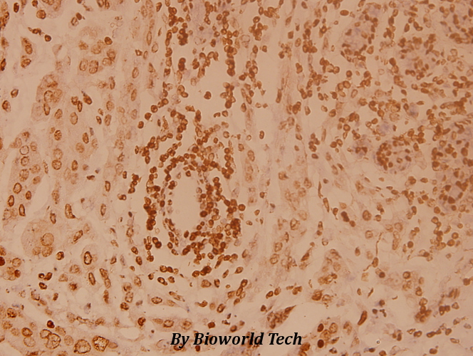 Immunohistochemistry (IHC) analyzes of Elongin A1 (R129) pAb in paraffin-embedded human breast carcinoma tissue at 1:100.