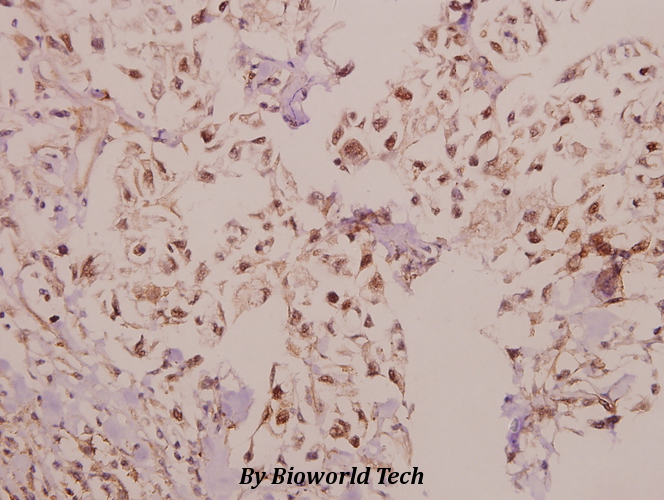 Immunohistochemistry (IHC) analyzes of Laminin α-4 (A511) pAb in paraffin-embedded human colorectal carcinoma tissue at 1:50.