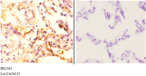 Immunohistochemistry (IHC) analyzes of PSMD2 (D636) pAb in paraffin-embedded human lung carcinoma tissue at 1:50.showing strong cytoplasmic positivity staining. Negative control (the right)Using PBS instead of primary antibody, secondary antibody is Goat Anti-Rabbit IgG-biotin followed by avidin-peroxidase.