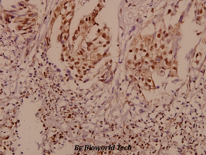 Immunohistochemistry (IHC) analyzes of P-cadherin (G78) pAb in paraffin-embedded human breast carcinoma tissue at 1:50.