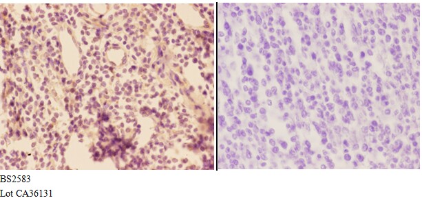 Immunohistochemistry (IHC) analyzes of ADORA3 (E318) pAb in paraffin-embedded human tonsil carcinoma tissue at 1:50,showing cytoplasm and membrane staining.Negative control (the right)Using PBS instead of primary antibody, secondary antibody is Goat Anti-Rabbit IgG-biotin followed by avidin-peroxidase.