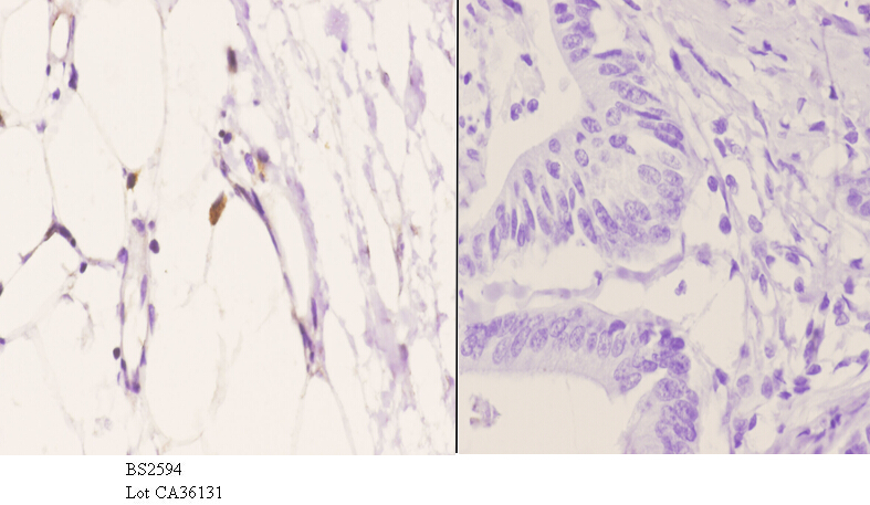 Immunohistochemistry (IHC) analyzes of EDG-5 (L303) pAb in paraffin-embedded human colon carcinoma tissue at 1:50.showing cytoplasmic and membrane staining. Negative control (the right)Using PBS instead of primary antibody, secondary antibody is Goat Anti-Rabbit IgG-biotin followed by avidin-peroxidase.