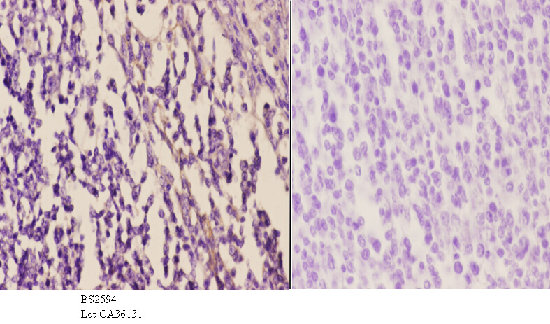 Immunohistochemistry (IHC) analyzes of EDG-5 (L303) pAb in paraffin-embedded human tonsil carcinoma tissue at 1:50.showing cytoplasmic and cell membrane staining. Negative control (the right)Using PBS instead of primary antibody, secondary antibody is Goa
