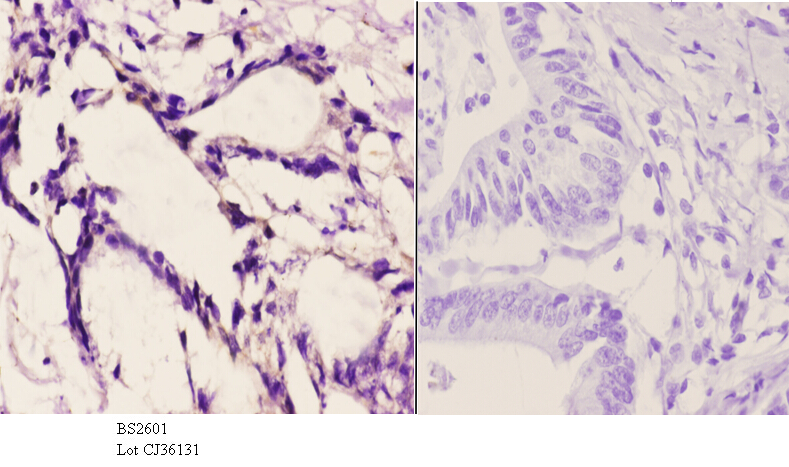 Immunohistochemistry (IHC) analyzes of Frizzled-10 (L164) pAb in paraffin-embedded human colon carcinoma tissue at 1:50.showing cell membrane staining. Negative control (the right)Using PBS instead of primary antibody, secondary antibody is Goat Anti-Rabbit IgG-biotin followed by avidin-peroxidase.