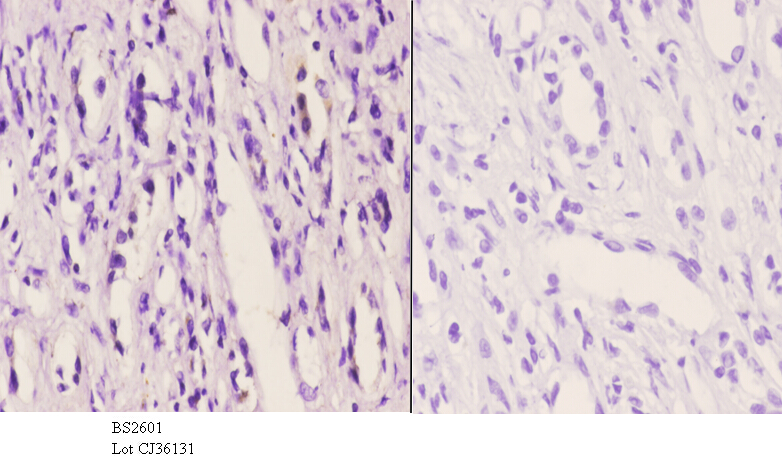 Immunohistochemistry (IHC) analyzes of Frizzled-10 (L164) pAb in paraffin-embedded human kidney carcinoma tissue at 1:50.showing cell membrane staining. Negative control (the right)Using PBS instead of primary antibody, secondary antibody is Goat Anti-Rab