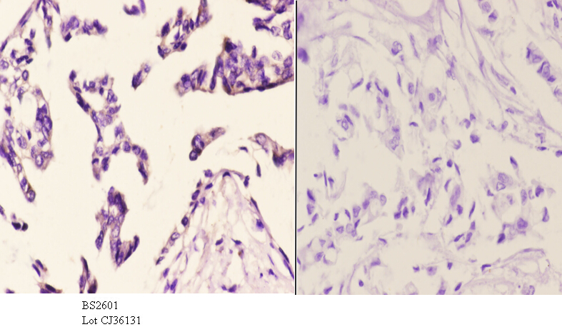 Immunohistochemistry (IHC) analyzes of Frizzled-10 (L164) pAb in paraffin-embedded human breast carcinoma tissue at 1:50.showing cell membrane staining. Negative control (the right)Using PBS instead of primary antibody, secondary antibody is Goat Anti-Rab