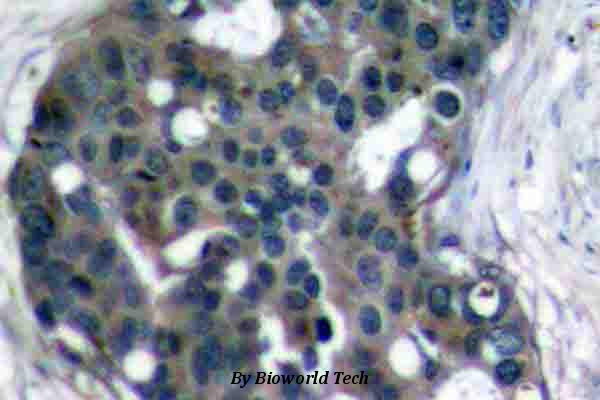 Immunohistochemistry (IHC) analyzes of Dok-2 (R293) pAb in paraffin-embedded human breast carcinoma tissue.