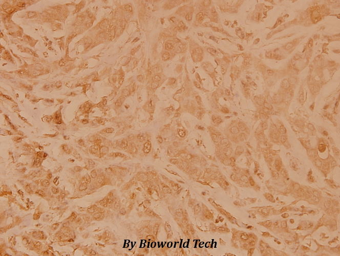 Immunohistochemistry (IHC) analyzes of Topo IIα (E1102) pAb in paraffin-embedded human breast carcinoma tissue at 1:100.