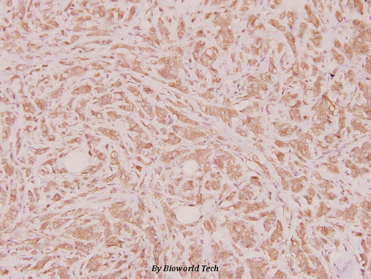 Immunohistochemistry (IHC) analyzes of HoxD12 (E230) pAb in paraffin-embedded human breast carcinoma tissue at 1:100.