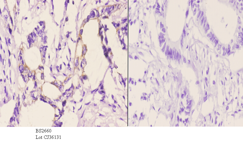Immunohistochemistry (IHC) analyzes of Rho H (M134) pAb in paraffin-embedded human rectum carcinoma tissue at 1:50.showing cytoplasmic and cell membrane staining. Negative control (the right)Using PBS instead of primary antibody, secondary antibody is Goat Anti-Rabbit IgG-biotin followed by avidin-peroxidase.
