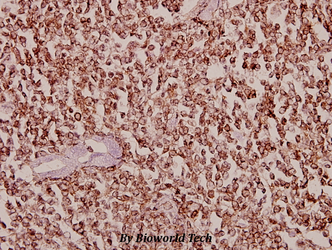 Immunohistochemistry (IHC) analyzes of Dyrk1B (T356) pAb in paraffin-embedded human tonsil carcinoma tissue at 1:50.