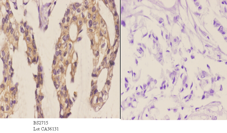 Immunohistochemistry (IHC) analyzes of Frizzled-8 (K528) pAb in paraffin-embedded human breast carcinoma tissue at 1:50.showing cell membrane staining. Negative control (the right)Using PBS instead of primary antibody, secondary antibody is Goat Anti-Rabbit IgG-biotin followed by avidin-peroxidase.