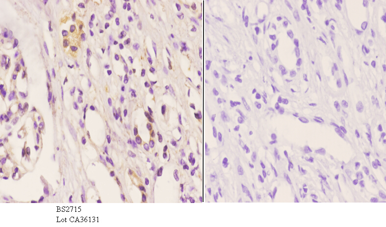 Immunohistochemistry (IHC) analyzes of Frizzled-8 (K528) pAb in paraffin-embedded human kidney carcinoma tissue at 1:50.showing cell membrane staining. Negative control (the right)Using PBS instead of primary antibody, secondary antibody is Goat Anti-Rabbit IgG-biotin followed by avidin-peroxidase.
