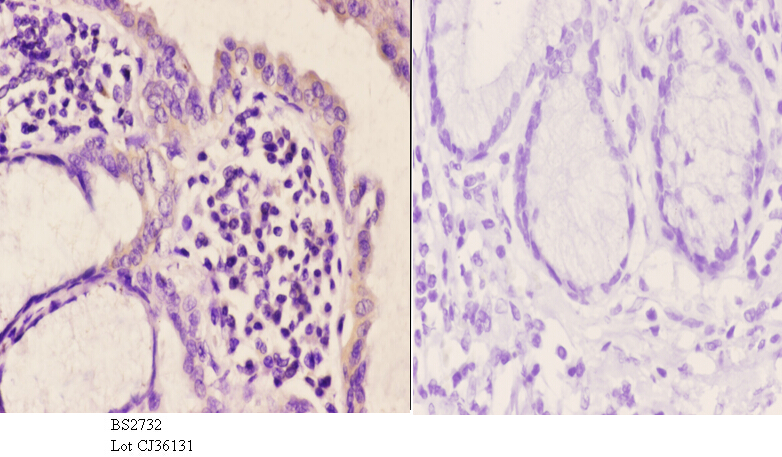 Immunohistochemistry (IHC) analyzes of mGluR-5 (K56) pAb in paraffin-embedded human esophageal carcinoma tissue at 1:50.showing cell membrane staining. Negative control (the right)Using PBS instead of primary antibody, secondary antibody is Goat Anti-Rabbit IgG-biotin followed by avidin-peroxidase.