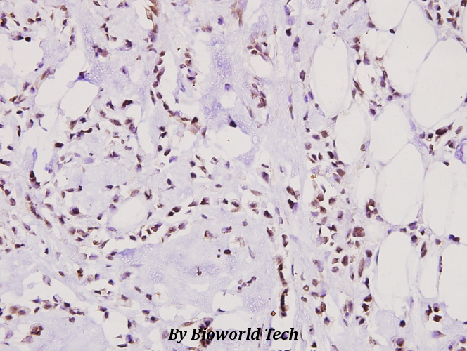 Immunohistochemistry (IHC) analyzes of hnRNP M (P43) pAb in paraffin-embedded human breast carcinoma tissue at 1:100.