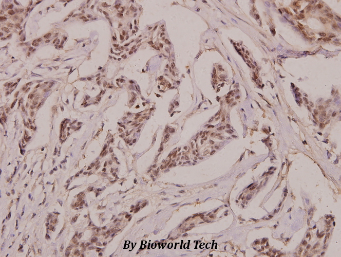 Immunohistochemistry (IHC) analyzes of Laminin β-2 (C91) pAb in paraffin-embedded human breast carcinoma tissue at 1:100.