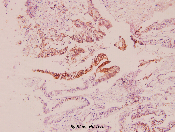 Immunohistochemistry (IHC) analyzes of PI3K p85β (Q496) pAb in paraffin-embedded human colorectal cancer carcinoma tissue at 1:100.