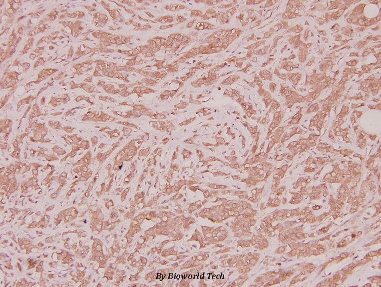Immunohistochemistry (IHC) analyzes of CLN1 (I65) pAb in paraffin-embedded human breast carcinoma tissue at 1:100.