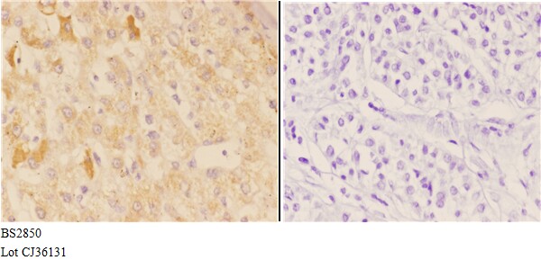 Immunohistochemistry (IHC) analyzes of AChRα1 (E217) pAb bin paraffin-embedded human liver carcinoma tissue at 1:50,showing membrnae and cytoplasmic staining.Negative control (the right)Using PBS instead of primary antibody, secondary antibody is Goat Anti-Rabbit IgG-biotin followed by avidin-peroxidase.