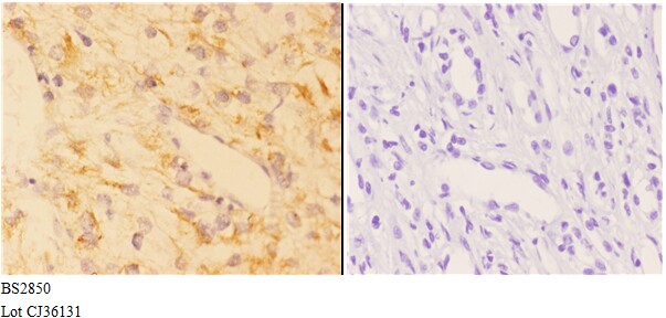 Immunohistochemistry (IHC) analyzes of AChRα1 (E217) pAb bin paraffin-embedded human kidney carcinoma tissue at 1:50,showing membrnae and cytoplasmic staining.Negative control (the right)Using PBS instead of primary antibody, secondary antibody is Goat An