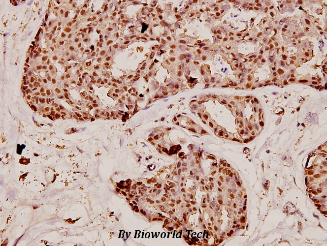 Immunohistochemistry (IHC) analyzes of CPN1 (M25) pAb in paraffin-embedded human breast carcinoma tissue at 1:100.