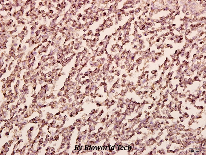 Immunohistochemistry (IHC) analyzes of PFKP (E369) pAb in paraffin-embedded human tonsil carcinoma tissue at 1:50.