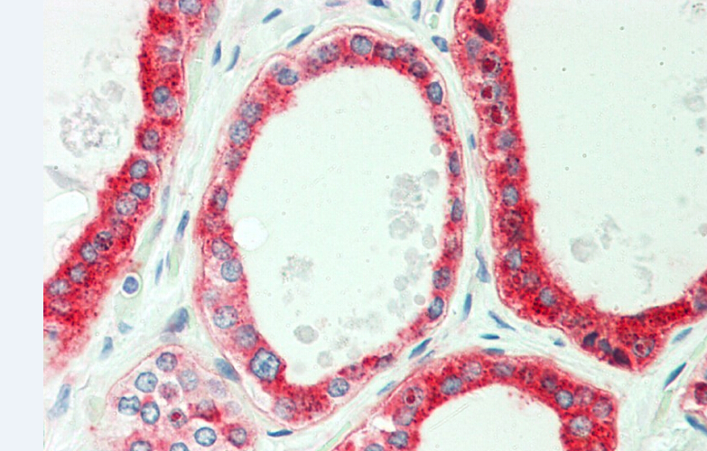 Immunohistochemistry (IHC) analyzes of PFKP (E369) pAb in paraffin-embedded human thyroid tissue at 1:70.