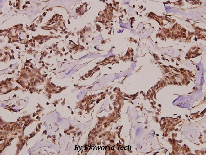 Immunohistochemistry (IHC) analyzes of Synphilin-1 (R846) pAb in paraffin-embedded human breast carcinoma tissue at 1:100.