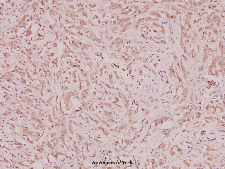 Immunohistochemistry (IHC) analyzes of ARA70 (L379) pAb in paraffin-embedded human breast carcinoma tissue at 1:100.
