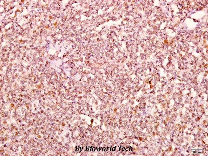 Immunohistochemistry (IHC) analyzes of Catenin-δ1 (G224) pAb in paraffin-embedded human tonsil carcinoma tissue at 1:50.